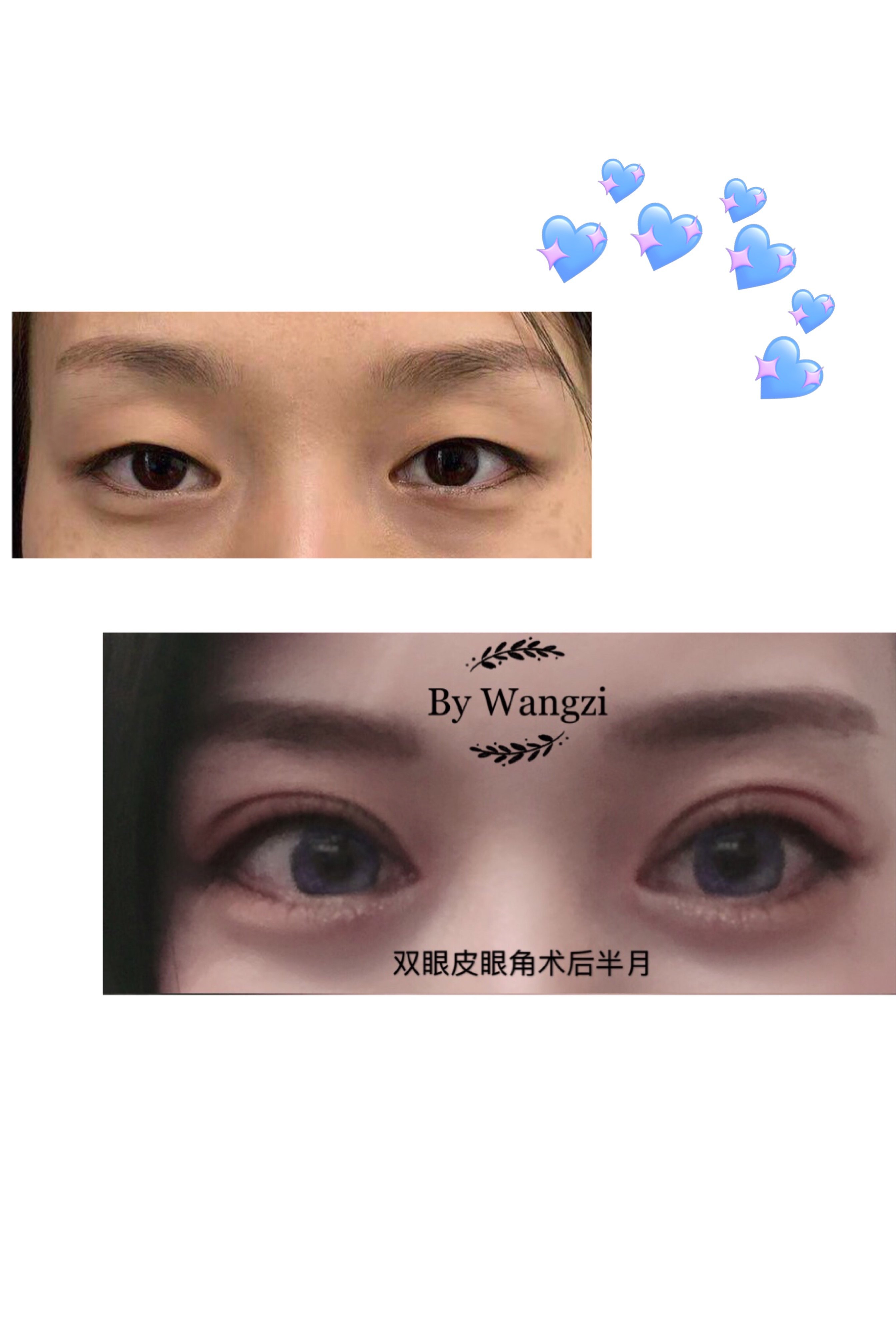 全切双眼皮开眼角拆线后能洗吗_三点定位双眼皮术后_做双眼皮的最佳时间点