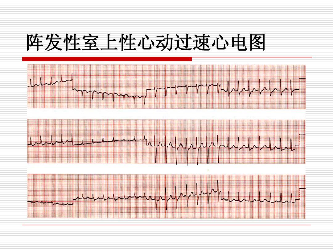 阵发性心房扑动吃什么药_阵发性心房扑动的治疗_阵发性室上性心动过扑